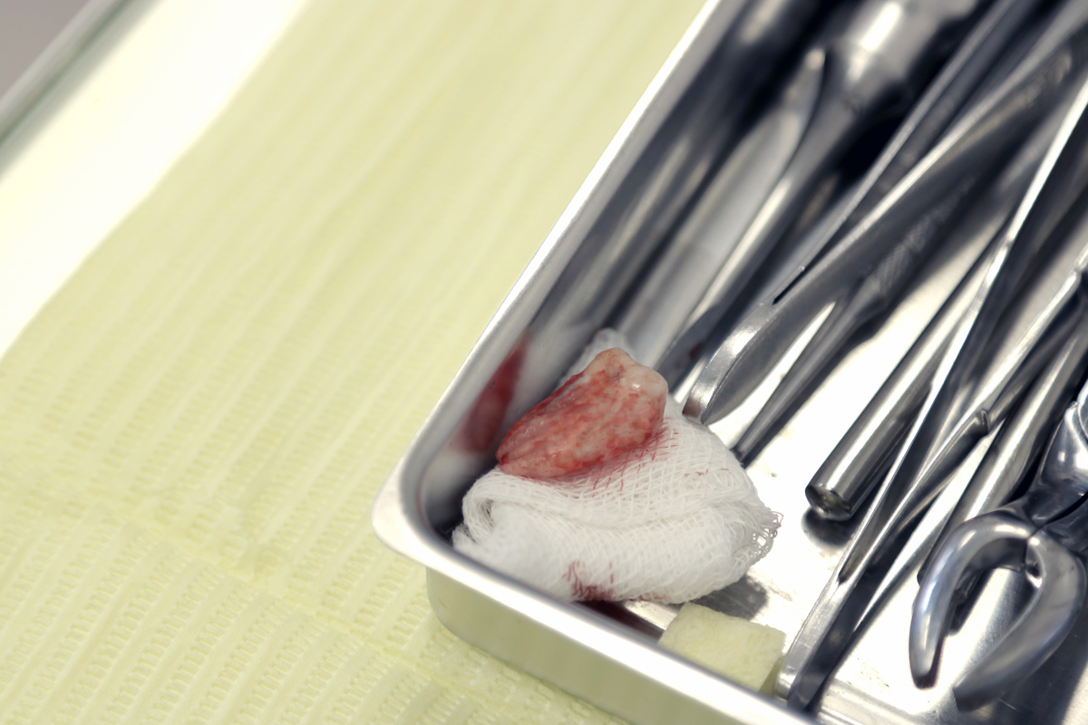 Как проводится удаление зубов в стоматологической клинике доктора Осиповой
